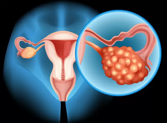 Managing Pcos Tips