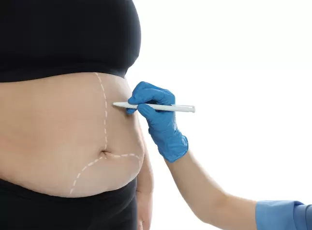What Is Bariatric Surgery Weight Loss Guide