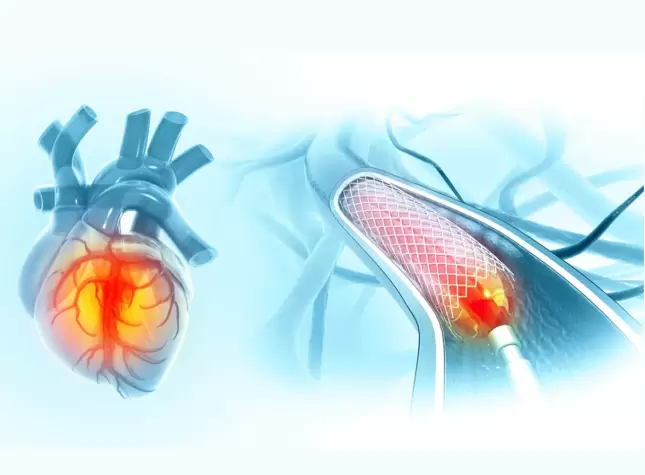 Angioplasty Cost Kolkata